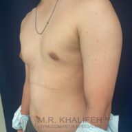 A shirtless person stands at an angle showing their upper body and chest; a necklace is visible and there is text at the bottom reading “M.R. Khalifeh MD Gynecomastia Specialist.”.