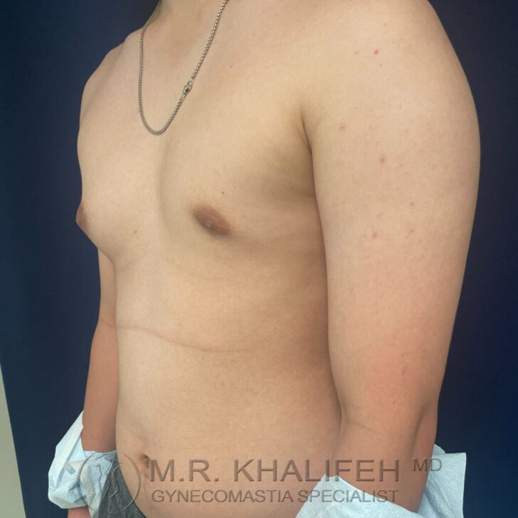A shirtless person stands at an angle showing their upper body and chest; a necklace is visible and there is text at the bottom reading “M.R. Khalifeh MD Gynecomastia Specialist.”.