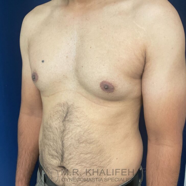 A shirtless adult male with visible gynecomastia, showing enlarged breast tissue on both sides of the chest.