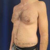 Shirtless adult male standing against a dark background, showing asymmetrical chest with visible enlargement of the left breast.