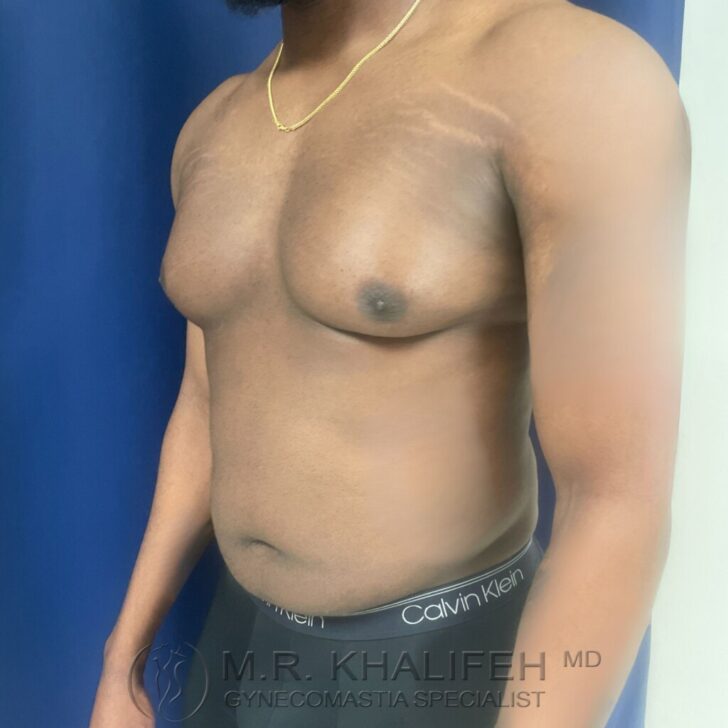 A shirtless adult male with visible enlargement of breast tissue, standing sideways against a blue background.