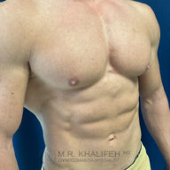 Shirtless male torso displaying defined chest and abdominal muscles against a blue background. The watermark reads "M.R. Khalifeh MD Gynecomastia Specialist.