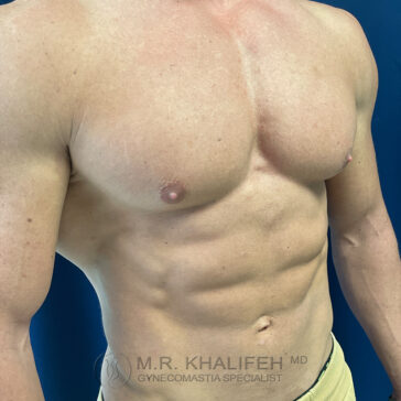 Shirtless male torso displaying defined chest and abdominal muscles against a blue background. The watermark reads "M.R. Khalifeh MD Gynecomastia Specialist.