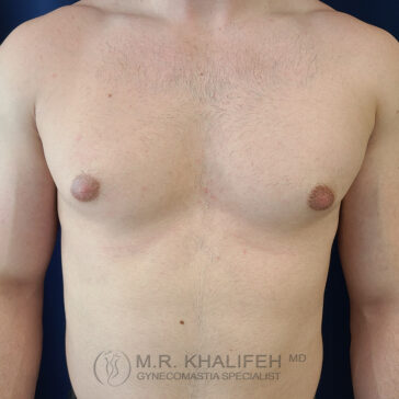 Shirtless male torso with visible gynecomastia, against a dark background. Medical watermark at bottom reads "M.R. Khalifeh MD Gynecomastia Specialist.