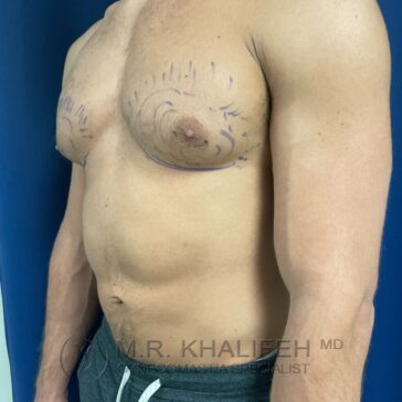 A shirtless man with surgical markings on his chest, standing against a blue background, preparing for a possible medical procedure.