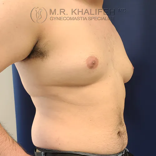 A shirtless adult male with an enlarged breast indicative of gynecomastia, standing in profile against a blue background.