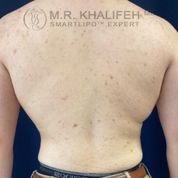 A person's bare back with visible acne and blemishes, wearing brown pants and standing against a dark blue background.