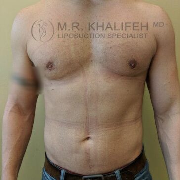 Shirtless male torso with faint post-surgical lines and markings on the chest and abdomen, standing against a plain background.