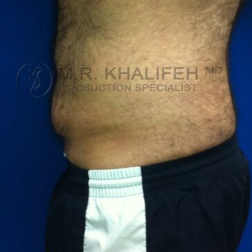A man's abdomen is shown in profile, displaying excess fat above the waistline. He is wearing black and white shorts and standing against a blue background.