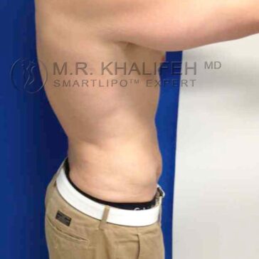 Person standing sideways, showing bare upper torso and lower face, wearing beige pants; background is plain, with a logo watermark overlay from "M.R. Khalifeh MD SMARTLIPO™ EXPERT.