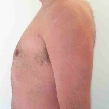 A shirtless person is shown from the side with their right arm relaxed, against a plain white background.