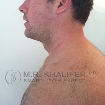Profile of a shirtless man's lower face, neck, and upper chest with slight stubble; logo and text "M.R. Khalifeh MD Smartlipo Expert" overlayed on the image.