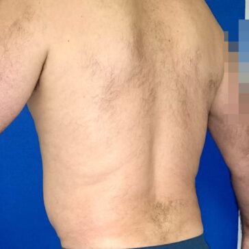 A person with a bare back stands against a blue background. The upper body and part of the right arm are visible.
