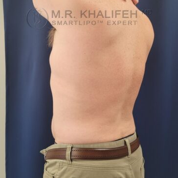 A person’s bare torso is shown from the side against a blue background, wearing khaki pants and a brown belt. Logo and text for "M.R. Khalifeh MD SmartLipo Expert" are visible at the top.