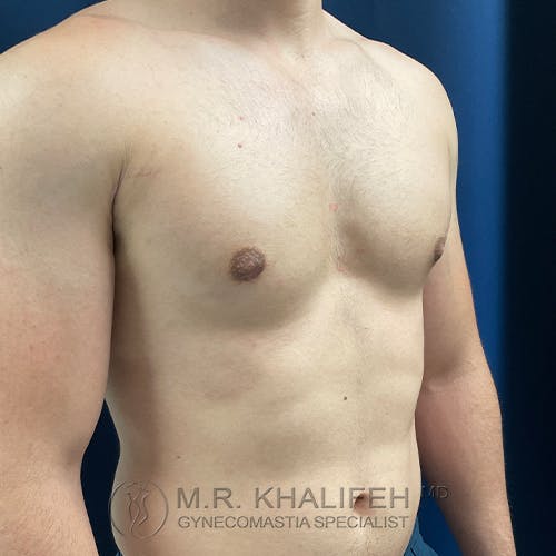 A shirtless person with a bare chest stands in front of a blue background. Text at the bottom reads “M.R. Khalifeh MD Gynecomastia Specialist.”.
