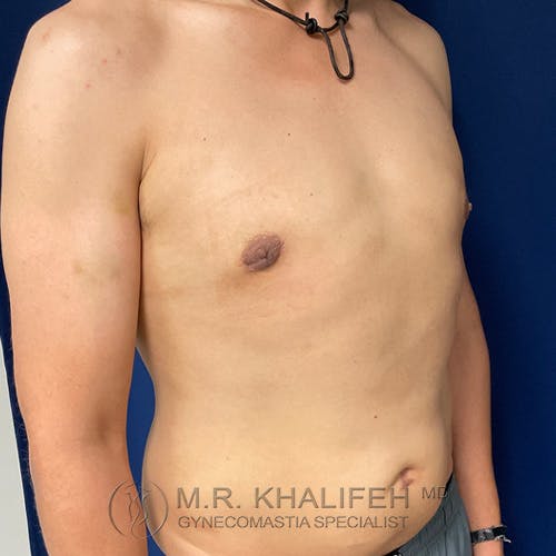 A shirtless person stands at an angle against a blue background, showing a flat chest with minimal visible scarring. Text at the bottom reads "M.R. Khalifeh MD Gynecomastia Specialist.