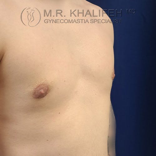 A close-up of a person's bare chest with mild gynecomastia, against a blue background. The logo of a gynecomastia specialist is visible in the upper left corner.