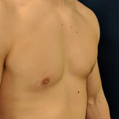 A close-up of a person's bare chest and shoulder against a dark background.