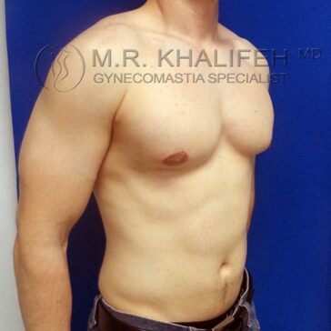 A shirtless man standing against a blue background, showing his chest and upper body with noticeable gynecomastia on one side.