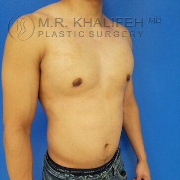 A shirtless male torso is shown against a blue background, with "M.R. Khalifeh MD Plastic Surgery" watermark across the image.