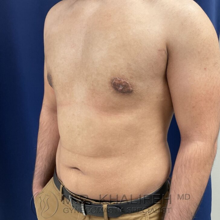 A shirtless person with a flat chest and visible surgical scars around the areolas, standing against a blue background.