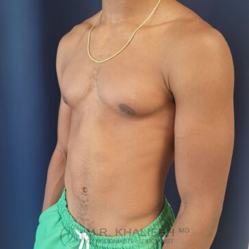 A shirtless man with a gold chain and green shorts stands against a dark blue background, displaying a slightly raised area around his chest.