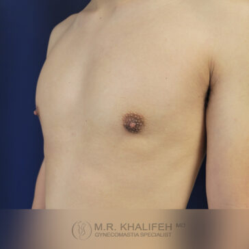 A shirtless person shown from the shoulders to the waist, displaying a flat chest. The image includes a logo and text for a gynecomastia specialist at the bottom.