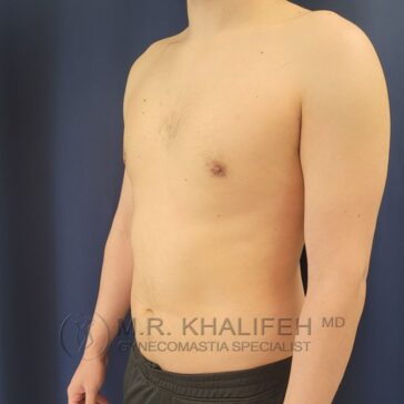A shirtless person stands against a dark blue background, shown from the waist up and turned slightly to the side. Text at the bottom reads "M.R. Khalifeh MD Gynecomastia Specialist.