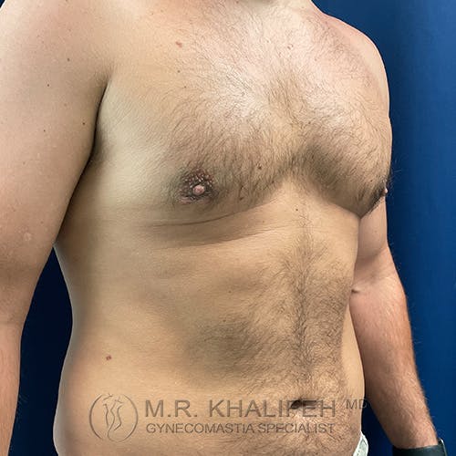 A shirtless adult male with slight chest enlargement, standing against a blue background. The image is watermarked with a gynecomastia specialist’s logo and name.