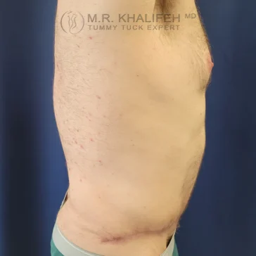 A person's torso shown in profile, with a visible scar near the lower abdomen, standing in front of a blue background.