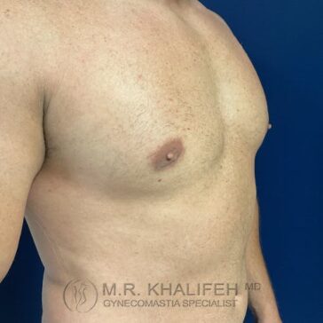 A shirtless adult male torso viewed from an angle, showing slight enlargement of breast tissue; blue background with "M.R. Khalifeh MD Gynecomastia Specialist" watermark.