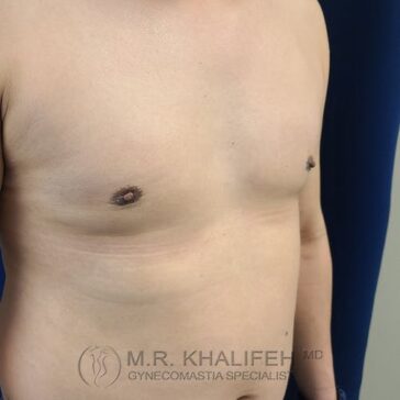 A person’s chest and upper abdomen shown from an angle, with visible surgical scars around the nipples; background is blue.