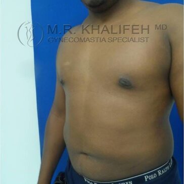 A man with mild gynecomastia stands shirtless against a blue and white background, showing his chest and upper abdomen. Text overlay reads "M.R. Khalifeh MD Gynecomastia Specialist.
