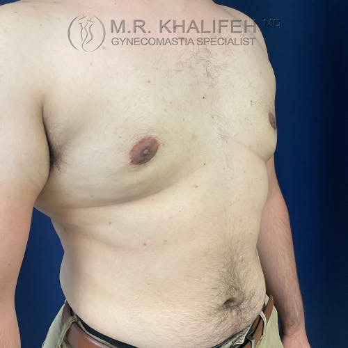 A shirtless adult male torso with visible gynecomastia, standing against a blue background. Logo and text for a gynecomastia specialist are overlaid at the top.