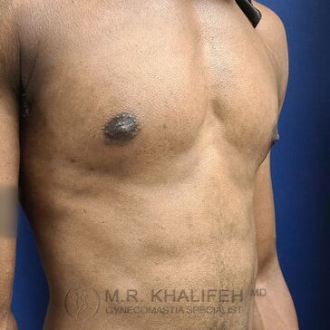 A male torso with mild gynecomastia, showing enlarged breast tissue under the left nipple, against a blue background.