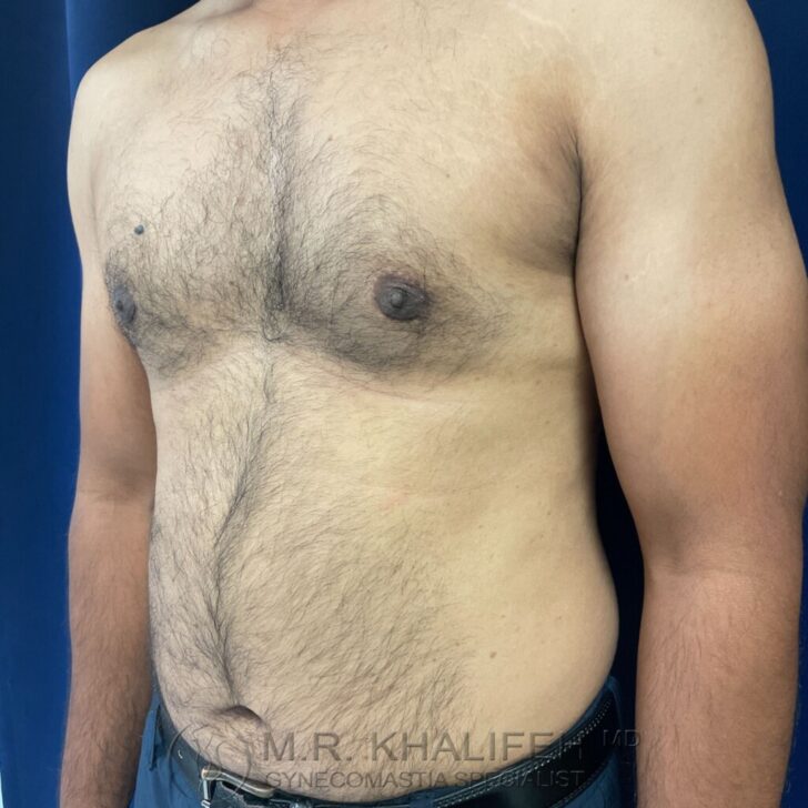 A shirtless adult male stands against a blue background, displaying visible gynecomastia and chest hair.