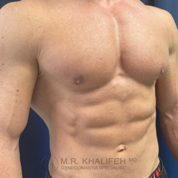 Shirtless male torso showing defined chest and abdominal muscles, standing against a blue background. Text overlay at the bottom reads "M.R. Khalifeh MD Gynecomastia Specialist.