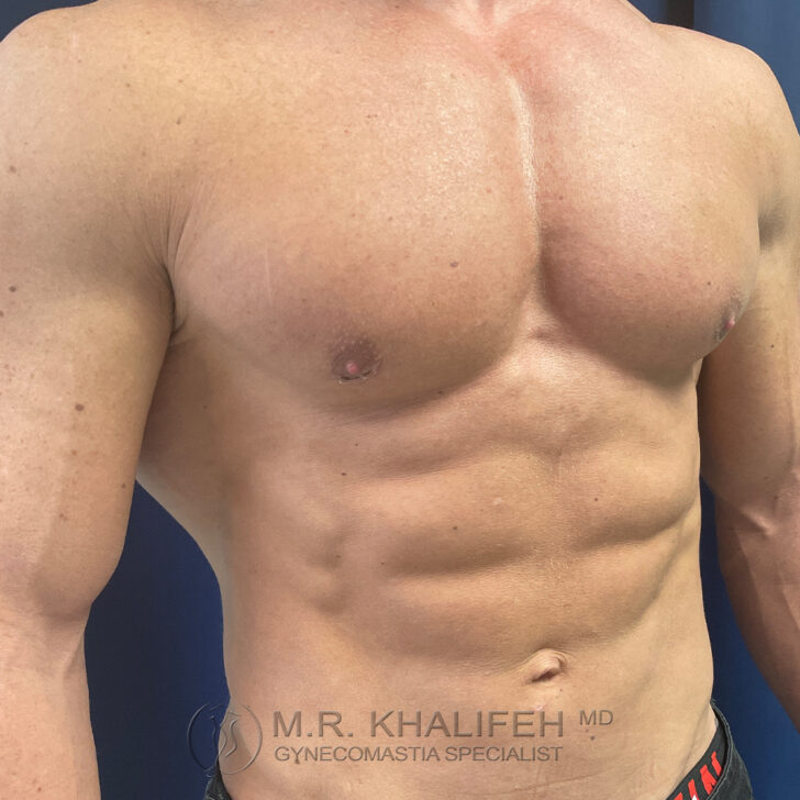 Shirtless male torso showing defined chest and abdominal muscles, standing against a blue background. Text overlay at the bottom reads "M.R. Khalifeh MD Gynecomastia Specialist.