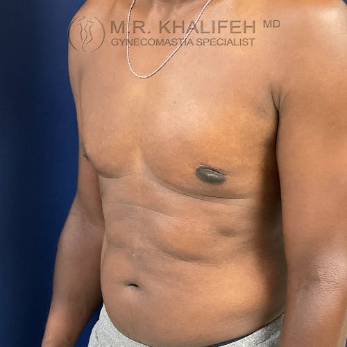 A shirtless man with visible gynecomastia stands at an angle, displaying his chest and abdomen. Text overlay reads “MR. KHALIFEH MD, GYNECOMASTIA SPECIALIST.”.