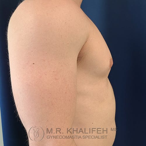 Side view of a shirtless adult male torso with visible gynecomastia, standing against a dark blue background.