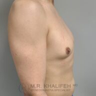 A person’s bare upper torso and arm are shown in profile against a gray background, with the logo "M.R. Khalifeh MD Gynecomastia Specialist" visible.