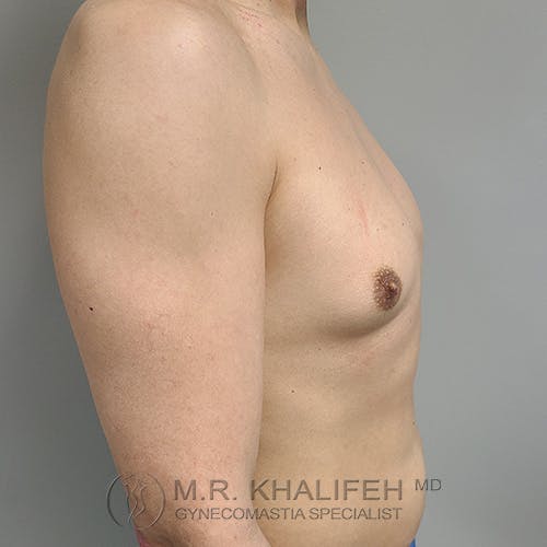A person’s bare upper torso and arm are shown in profile against a gray background, with the logo "M.R. Khalifeh MD Gynecomastia Specialist" visible.