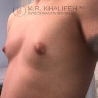 A close-up side view of a person's bare chest, showing symptoms of gynecomastia, with a watermark reading "M.R. Khalifeh MD, Gynecomastia Specialist.