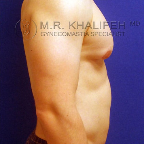 A shirtless person with visible gynecomastia stands in profile against a blue background. Text overlay reads "M.R. Khalifeh MD Gynecomastia Specialist.