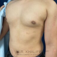 A person with a bare chest is standing against a blue background, partially covered by a light blue drape. The image contains a watermark with a doctor's name and gynecomastia specialist title.