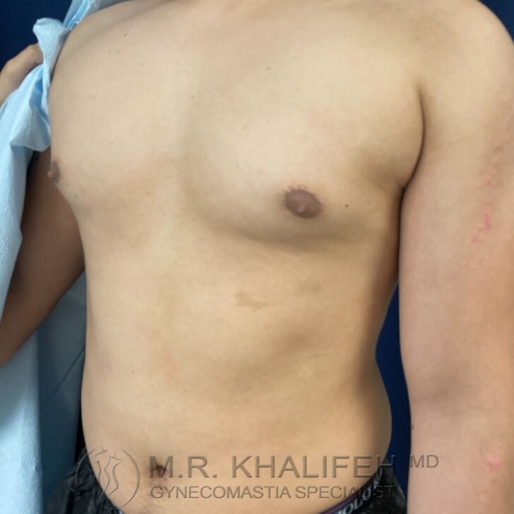 A person with a bare chest is standing against a blue background, partially covered by a light blue drape. The image contains a watermark with a doctor's name and gynecomastia specialist title.