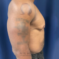 A shirtless person is shown from the side against a blue background, with a blurred tattoo on the upper arm and visible chest and abdomen.