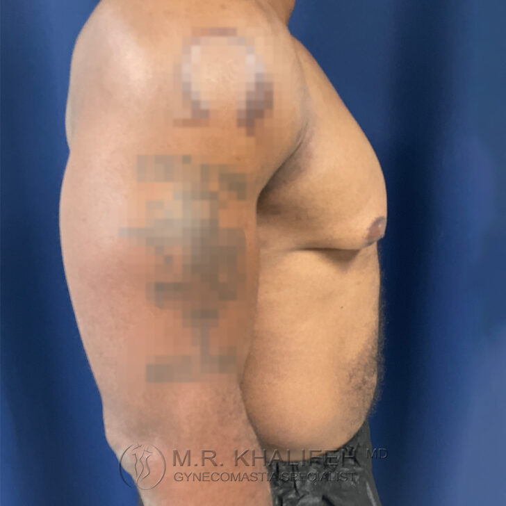 A shirtless person is shown from the side against a blue background, with a blurred tattoo on the upper arm and visible chest and abdomen.