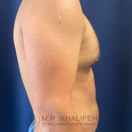 Side view of a shirtless male torso against a blue background, showing enlarged breast tissue. Text at the bottom reads "M.R. Khalifeh MD Gynecomastia Specialist.
