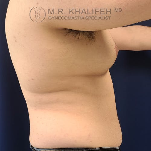Side view of a male torso showing chest and abdominal area with visible gynecomastia, against a dark background. Logo text reads "M.R. Khalifeh MD, Gynecomastia Specialist.